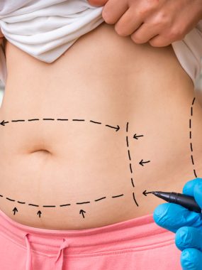 Plastic,Surgery,Doctor,Draw,Lines,With,Marker,On,Patient,Belly