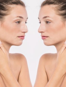 Revision Rhinoplasty1 Revision Rhinoplasty1