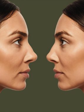 Revision Rhinoplasty2 Revision Rhinoplasty2